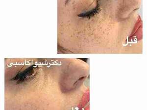 لیزر کردن کک و مک