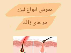 پیشنهاد آریادرم درباره لیزر