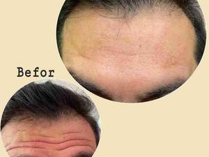 تزریق بوتاکس پیشانی و دور چشم