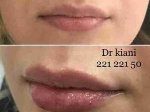 تزریق فیلر خط لبخند