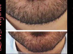 فرم دهی چانه و ایجاد زاویه فک با فیلر