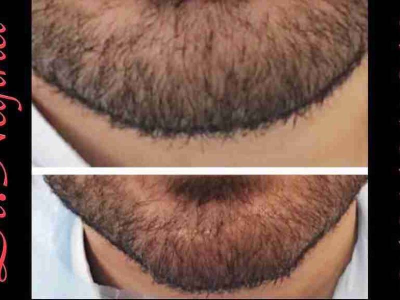 فرم دهی چانه و ایجاد زاویه فک با فیلر