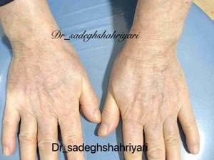 جوانسازی و از بین بردن ضایعات آفتابی
