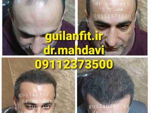 کلینیک کاشت مو گیلان فیت رشت_ دکترمهدوی