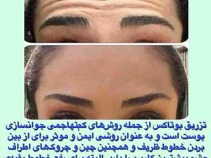 تزریق بوتاکس پیشانی