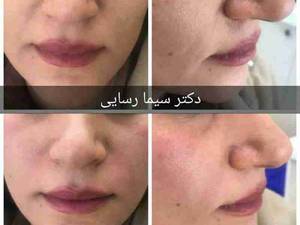 تزریق ژل برای خط خنده و گونه