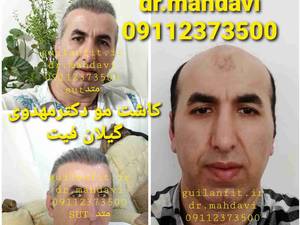 کلینیک کاشت مو گیلان فیت رشت _دکترمهدوی
