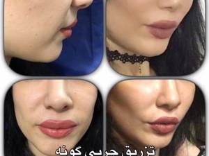 تزریق چربی