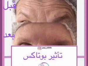 بوتاکس پیشانی