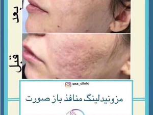 مزونیدلینگ منافذ باز صورت