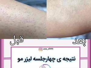 لیزر مو‌های زائد