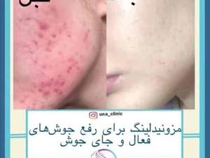 مزونیدلینگ برای رفع جوش های فعال