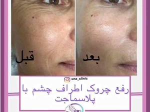 از بین بردن خطوط اطراف چشم با پلاسماجت