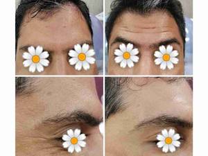 تزریق بوتاکس پیشانی در کلینیک آریادرم