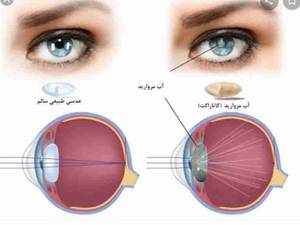 جراحی آب مروارید (کاتاراکت) در گیلان