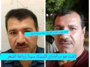 روش fuT و fuE برای به دست آوردن فولیکول در آبادان