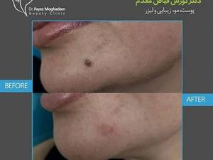 خال برداری با آر اف سرجیکال