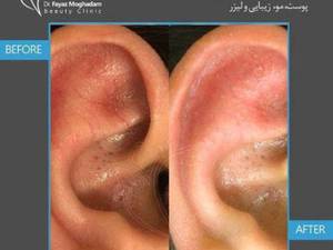 بعد از لیزر ضایعات عروقی