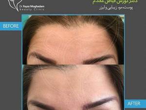 تزریق بوتاکس دیسپورت انگلیس