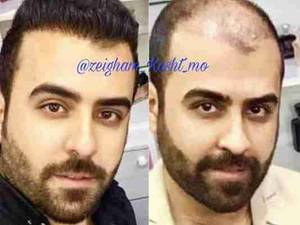 انجام کاشت مو در خرمشهر