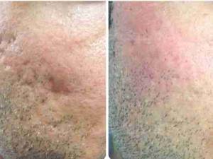 درمان اسکار و فرو رفتگی جای جوش با لیزر فرکشنال co2