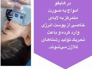 هایفو برای جوان سازی پوست