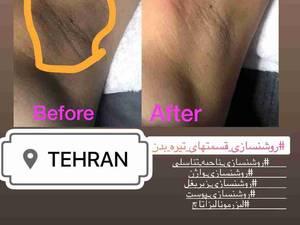 درمان سیاهی و تیرگی زیر بغل
