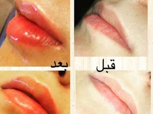 تزریق ژل لب