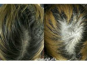 تاثیر پی آر پی و مزوتراپی مو