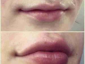 تزریق ژل لب در کلینیک آریادرم
