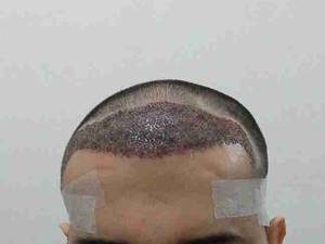 کاشت مو به روش FIT یا کاشت FUE
