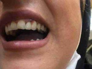 ایمپلنت در چالوس