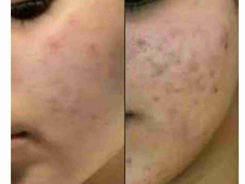 تاثیر کرم های گیاهی بر روی پوست های مستعد جوش و آکنه