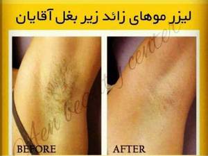 رفع لیزر موهای زائد بدن آقایان با لیزر بصورت تخصصی در اصفهان