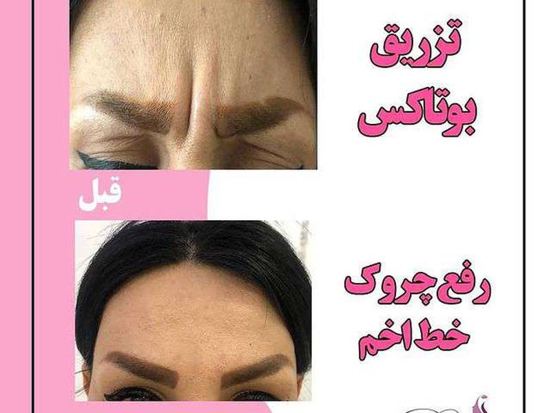 تزریق بوتاکس در شمال تهران