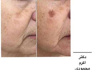 مزوتراپی و جوانسازی صورت