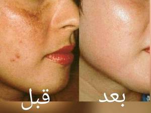 انجام پاکسازی پوست
