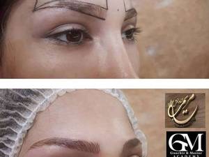 اجرای میکروبلیدینگ در رشت