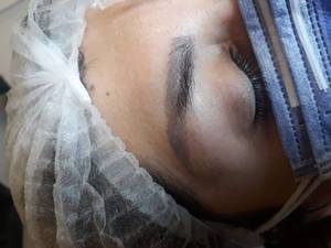 ریمو و پاک کردن تاتو ابرو در گیلان