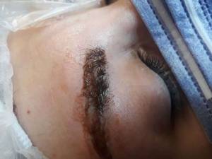 ریمو و پاک کردن تاتو ابرو در گیلان