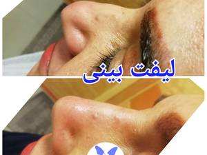 لیفت بینی