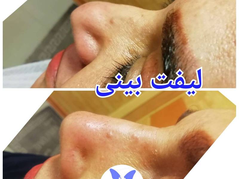 لیفت بینی
