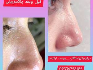 مرکز میکرواسکالپ در ساری مازندران