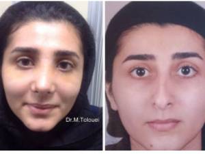 جراحى زيبايى بينى ، ٧ روز بعد از عمل