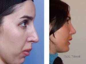 جراحى همزمان زيبايى بينى و زيبايى چانه (ژنيوپلاستى)