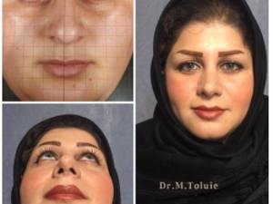 جراحي زيبايي بيني ، ١٥ ماه بعد از عمل