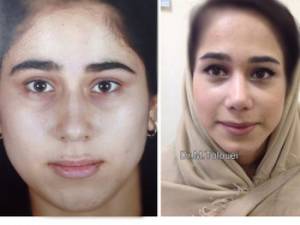 جراحى زيبايى بينى