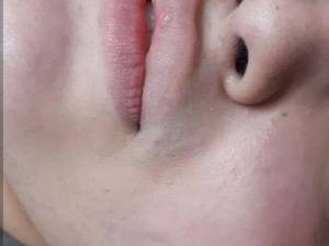 تزریق ژل لب به صورت کاملا تخصصی در کلینیک لیزر نازنین