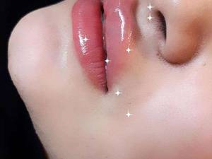 تزریق ژل لب به صورت کاملا تخصصی در کلینیک لیزر نازنین
