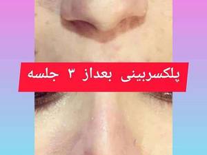 پلکسر بینی در ساری و تهران